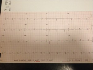 ECG taken in March 2015